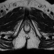 Lesion Detection Analysis